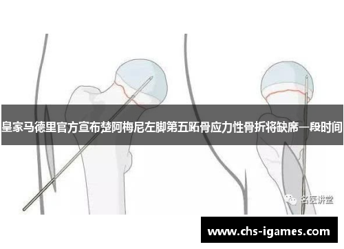 皇家马德里官方宣布楚阿梅尼左脚第五跖骨应力性骨折将缺席一段时间 皇家马德里官方宣布楚阿梅尼左脚第五跖骨应力性骨折将缺席一段时间